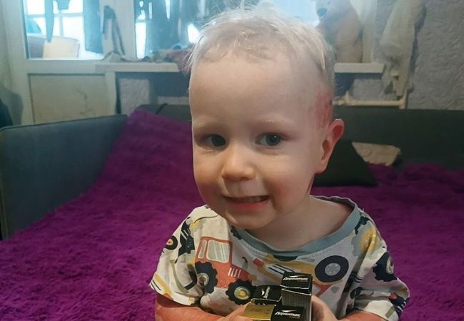 Мирон Брехер: перші кроки відновлення після важких опіків